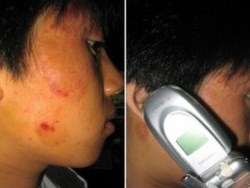 Egyre gyakoribb a mobiltelefon-allergia